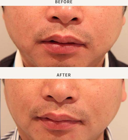 ANTI-WRINKLE INJECTION - MASSETER MUSCLE ENLARGEMENT