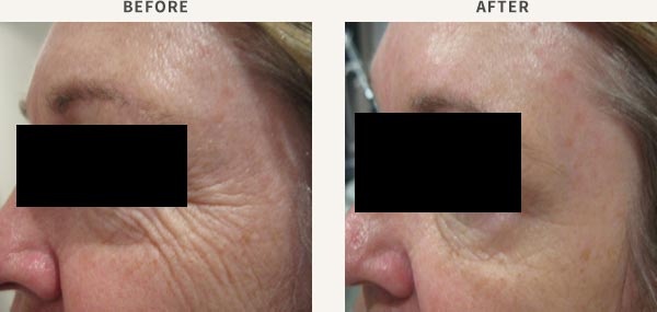 ANTI WRINKLE INJECTION - FOREHEAD & FROWN LINE