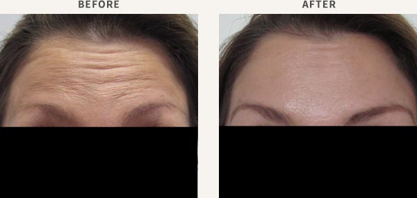 ANTI-WRINKLE INJECTION - FOREHEAD LINES