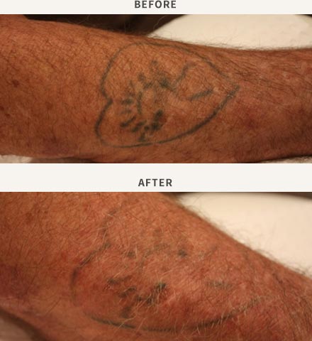 How does laser tattoo removal work? | Collins Cosmetic Clinic