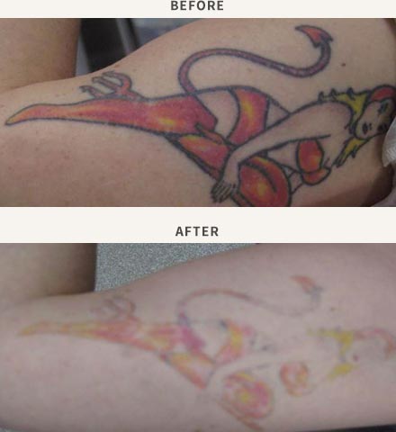 Laser tattoo removal on the rise as stats say one in three have regrets |  Daily Telegraph