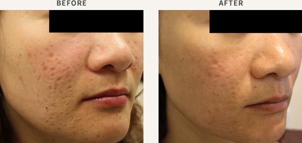 FRACTIONAL LASER RESURFACING - ACNE SCAR