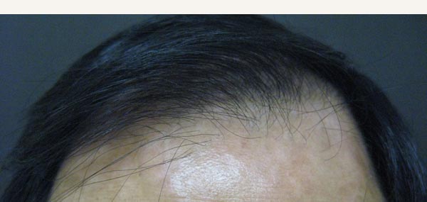 HAIR LOSS - MALE PATTERN ALOPECIA