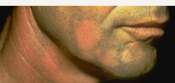HAIR LOSS - ALOPECIA AREATA