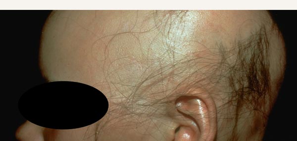 HAIR LOSS - ALOPECIA AREATA