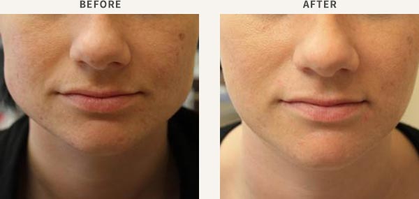ANTI-WRINKLE INJECTION - MASSETER MUSCLE ENLARGEMENT