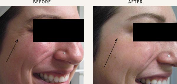 ANTI-WRINKLE INJECTION - CROWS FEET