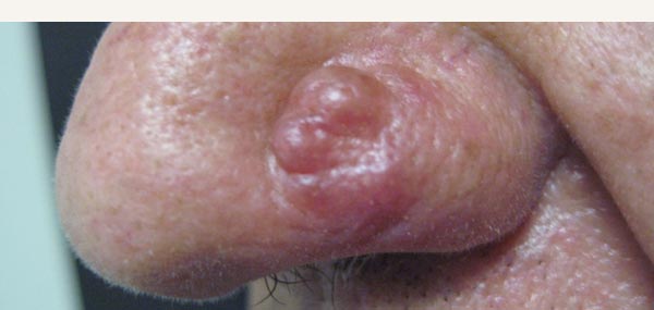 BASAL CELL CARCINOMA