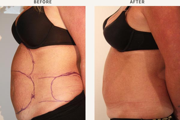BODY-JET LIPOSUCTION
