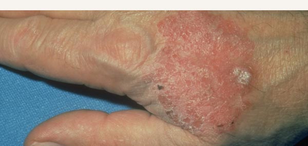 BOWEN'S DISEASE