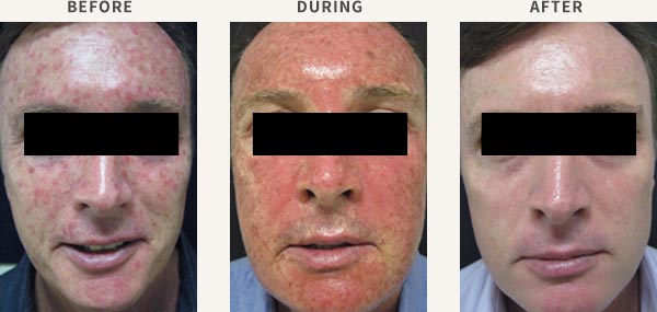 COMBINED IPL & PDT TREATMENT - ACTINIC DAMAGE