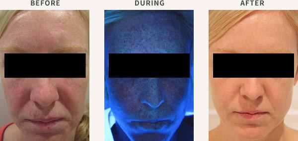 COMBINED IPL & PDT TREATMENT - ACTINIC DAMAGE