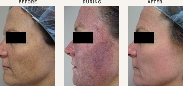 COMBINED IPL & PDT TREATMENT - ACTINIC DAMAGE