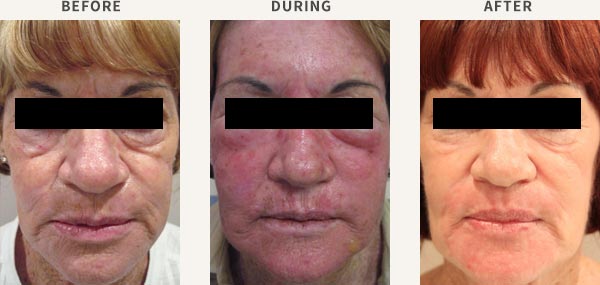 COMBINED IPL & PDT TREATMENT - ACTINIC DAMAGE