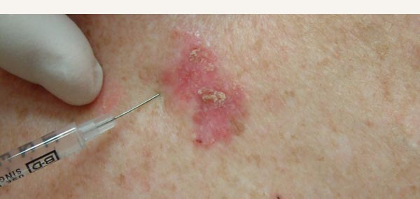 BOWEN'S DISEASE - TREATMENT WITH CURETTE AND CAUTERY
