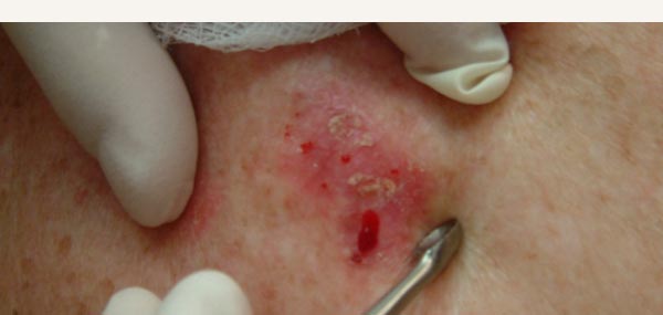 BOWEN'S DISEASE - TREATMENT WITH CURETTE AND CAUTERY