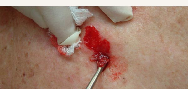 BOWEN'S DISEASE - TREATMENT WITH CURETTE AND CAUTERY