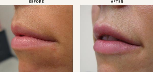 FILLER - LIP ENHANCEMENT