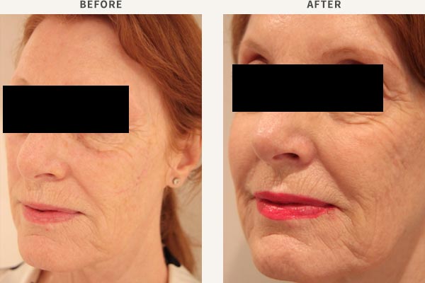ANTI-WRINKLE INJECTION - FROWN LINES, FOREHEAD, BROW LIFT, CROWS FEET FILLER - MID CHEEK ENHANCEMENT