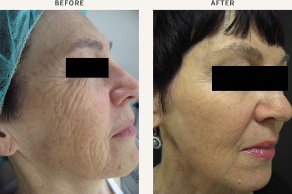 ANTI-WRINKLE INJECTION - FROWN LINES, FOREHEAD, BROW LIFT, CROWS FEET FILLER - MID CHEEK, TEMPLE & BROW ENHANCEMENT
BROADBAND LIGHT PHOTO-REJUVENATION - FULL FACE REJUVENATION