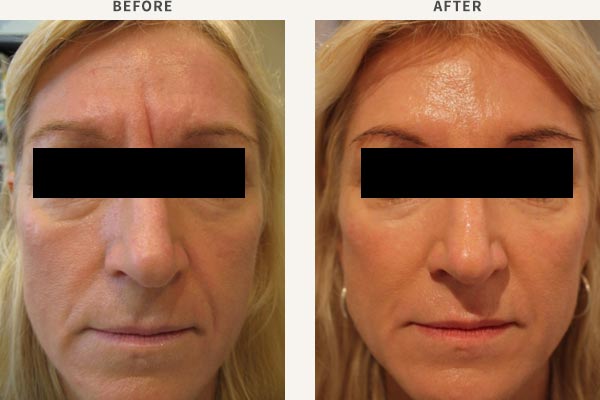 FILLER - MID CHEEK, TEMPLE & BROW ENHANCEMENT
ANTI-WRINKLE INJECTION - FROWN LINES, FOREHEAD, BROW LIFT, CROWS FEET