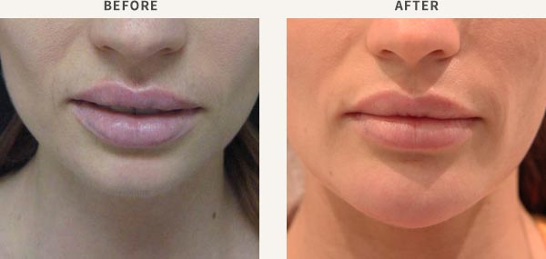 FILLER - LIP ENHANCEMENT