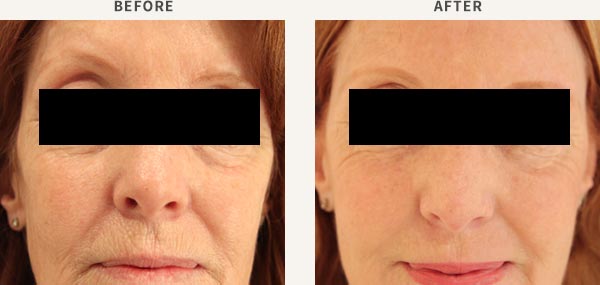 FILLER - TEAR TROUGH(EYE BAGS)