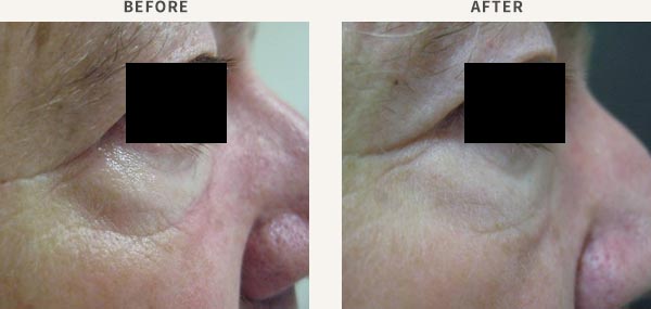 FILLER - TEAR TROUGH(EYE BAGS)