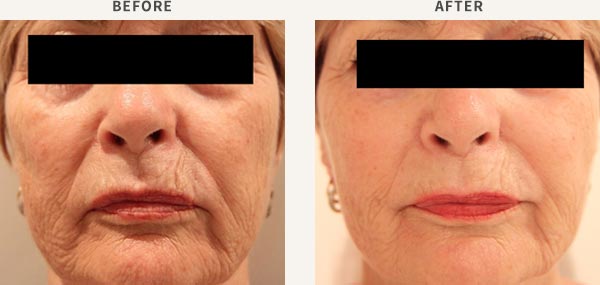 FILLER (MID CHEEK ENHANCEMENT)