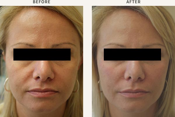 FILLER (MID CHEEK ENHANCEMENT)