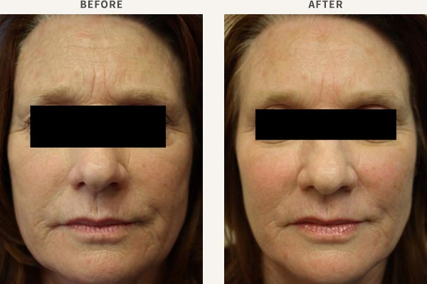 FILLER (MID CHEEK ENHANCEMENT)