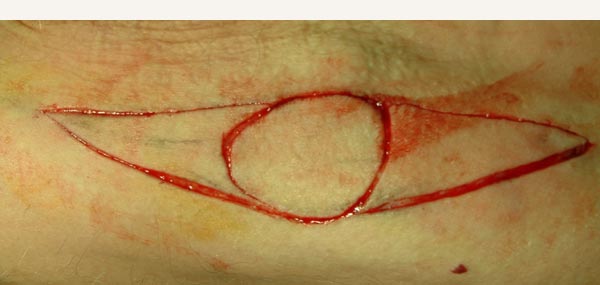 SKIN GRAFT - DONOR SITE
