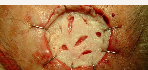 SKIN GRAFT STAPLED ONTO WOUND