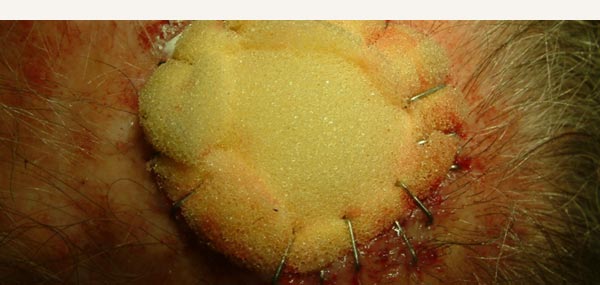 SKIN GRAFT SPONGE COMPRESSION BANDAGE STAPLED