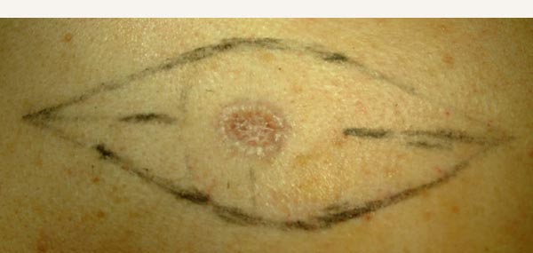 MELANOMA EXCISION - PRIMARY CLOSURE