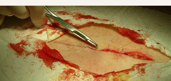 MELANOMA EXCISION - PRIMARY CLOSURE