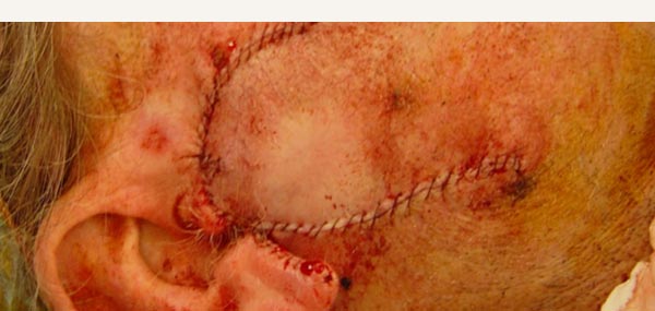 BOWEN'S DISEASE AND SQUAMOUS CELL CARCINOMA - BILOBE FLAP REPAIR