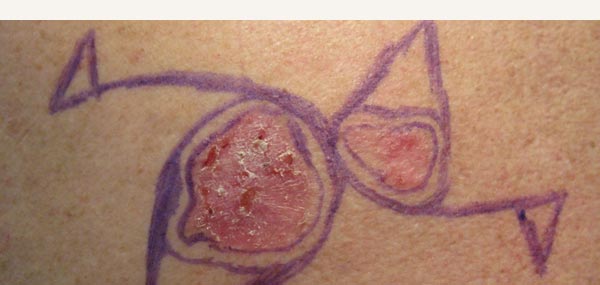 EXCISION OF BASAL CELL CARCINOMA - BILATERAL ADVANCEMENT FLAP REPAIR
