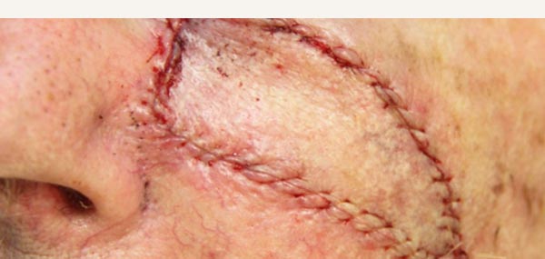 EXCISION OF SQUAMOUS CELL CARCINOMA - ISLAND PEDICLE FLAP REPAIR