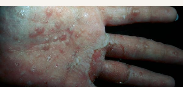 POMPHOLYX ECZEMA