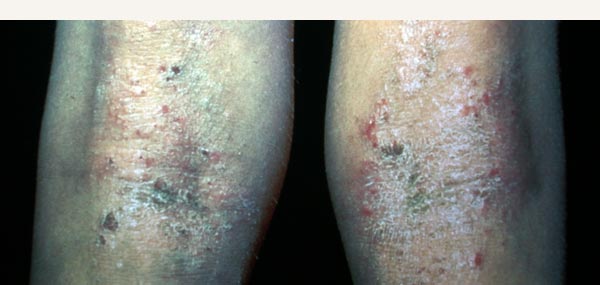ATOPIC ECZEMA