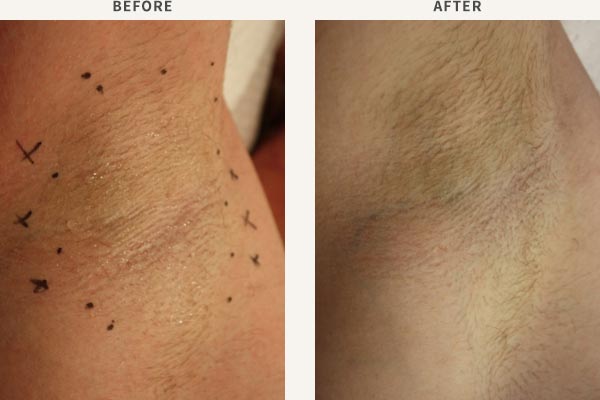 AXILLARY HYPERHIDROSIS - TREATMENT WITH BOTULINIUM TOXIN INJECTION