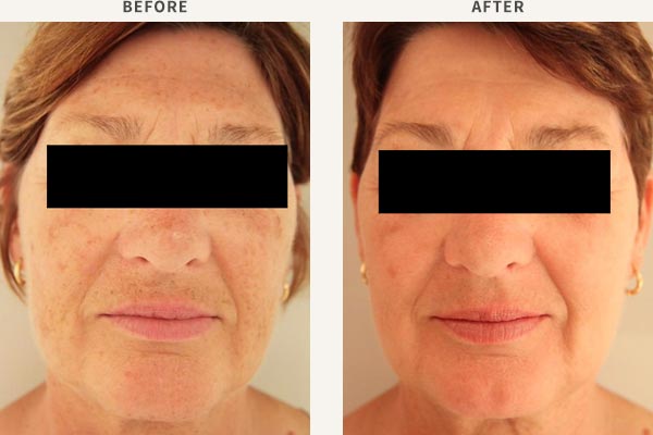 BROADBAND LIGHT PHOTO-REJUVENATION