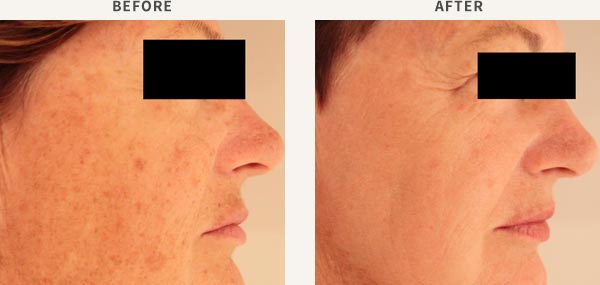 BROADBAND LIGHT PHOTO-REJUVENATION