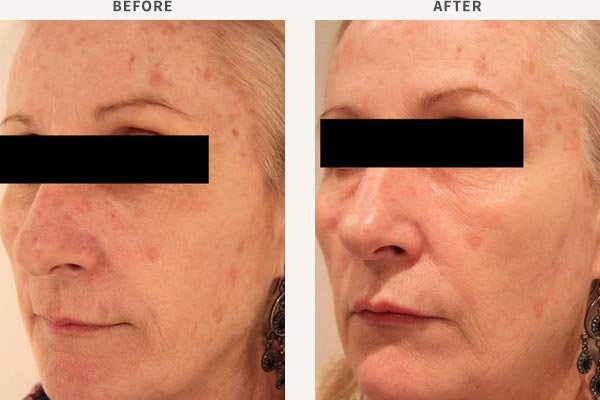BROADBAND LIGHT PHOTO-REJUVENATION