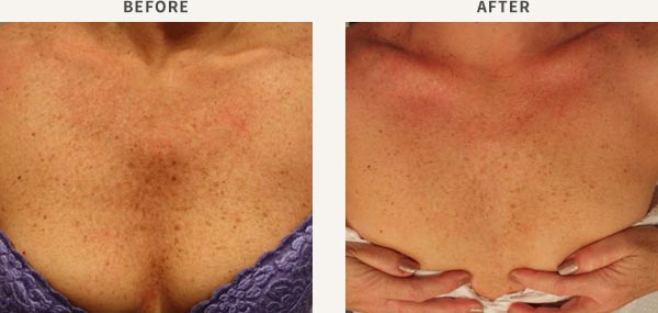 BROADBAND LIGHT PHOTO-REJUVENATION