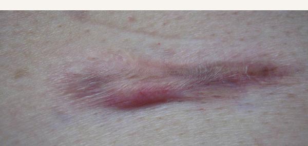 KELOID SCAR