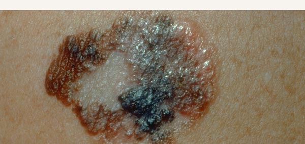 MELANOMA