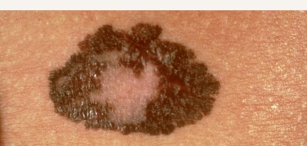 MELANOMA