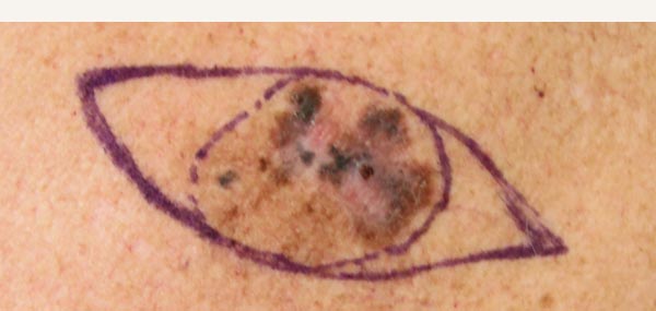 MELANOMA